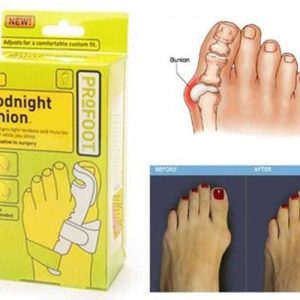 Longeta za ispravljanje čukljeva